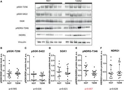 NDRG1 Activity in Fat Depots Is Associated With Type 2 Diabetes and Impaired Incretin Profile in Patients With Morbid Obesity